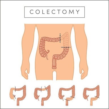 colectomy