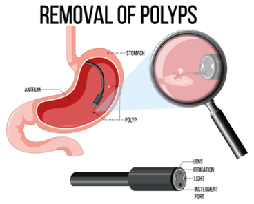 removal of polyps