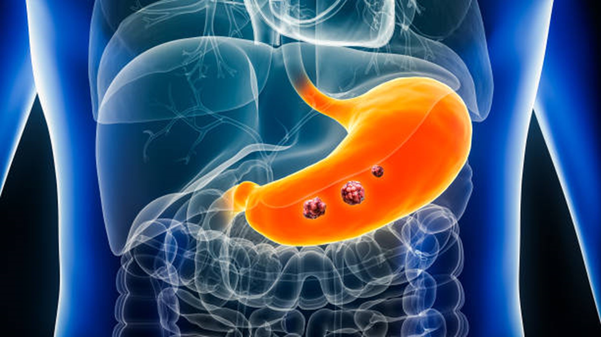 Battling Stomach Cancer At 30 Battling Stomach Cancer At 30